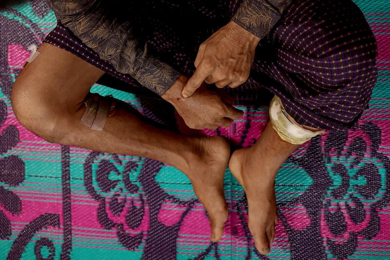 A Rohingya Muslim man who fled to Bangladesh from Maungdaw township in Myanmar shows his wounds after being injured in a drone attack on June 19, 2024. (Mohammad Ponir Hossain/Reuters)